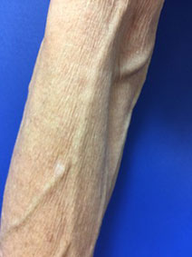 Vanish Vein Before & After Photos | Vanish Vein treats Varicose Veins